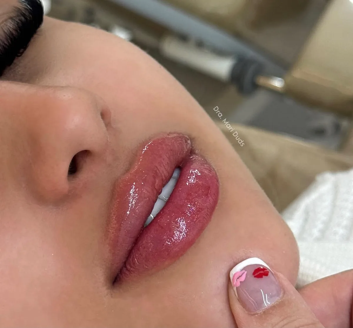 Resultado real de preenchimento labial realizado pela Dra. Mari Duds