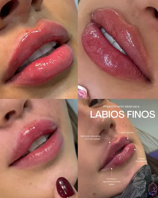 Mosaico com resultados reais de preenchimento labial